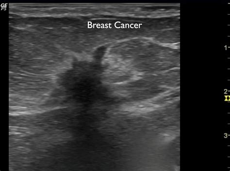 Breast Cancer Ultrasound: Uses, Procedure, and .